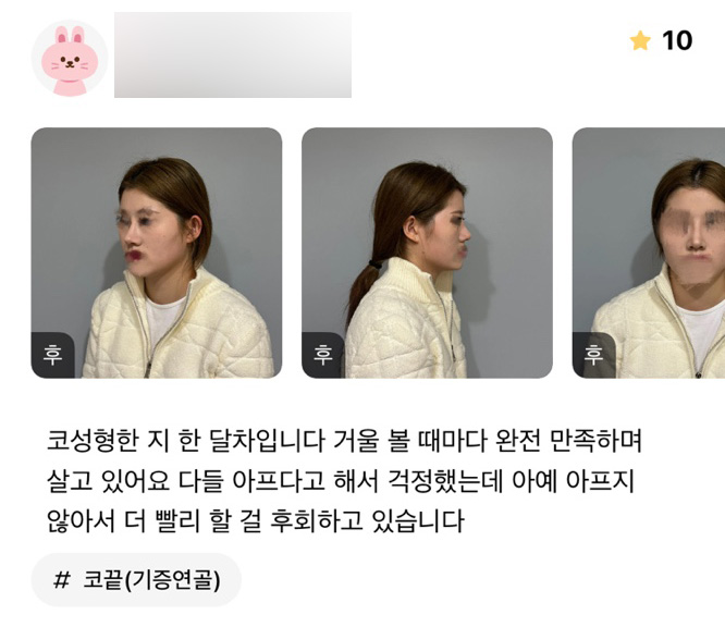 코성형 후기."더 빨리할 걸 후회하고 있습니다 !" 관련 이미지 1