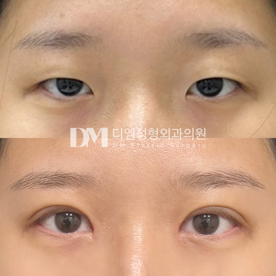 눈성형 후기."수술 후에도 지속적으로 관리해 주셔서 안심할 수 있었습니다!" 관련 이미지 2