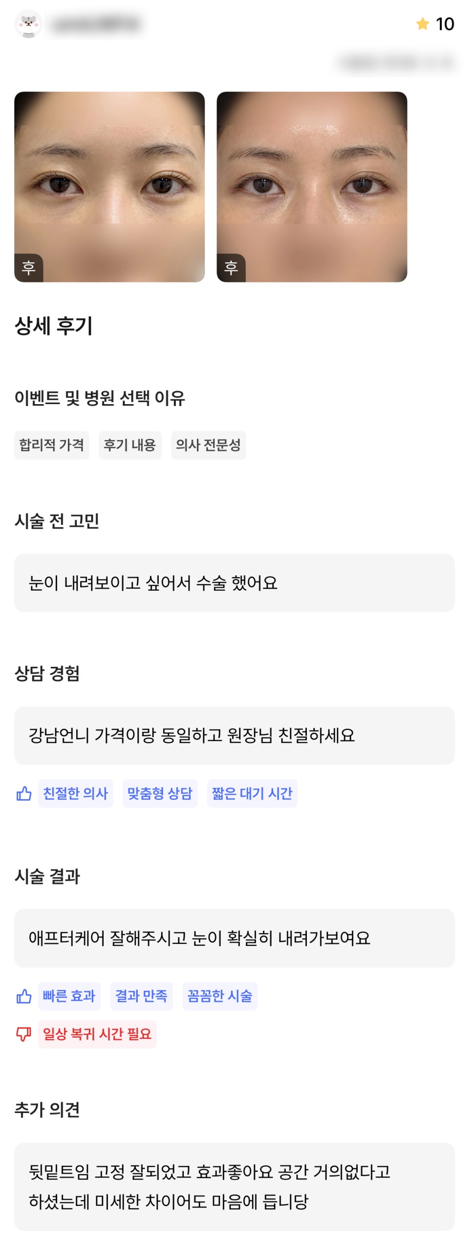 디엠 뒤밑트임 수술후기, “눈이 확실히 내려가 보여요!” 관련 이미지 1