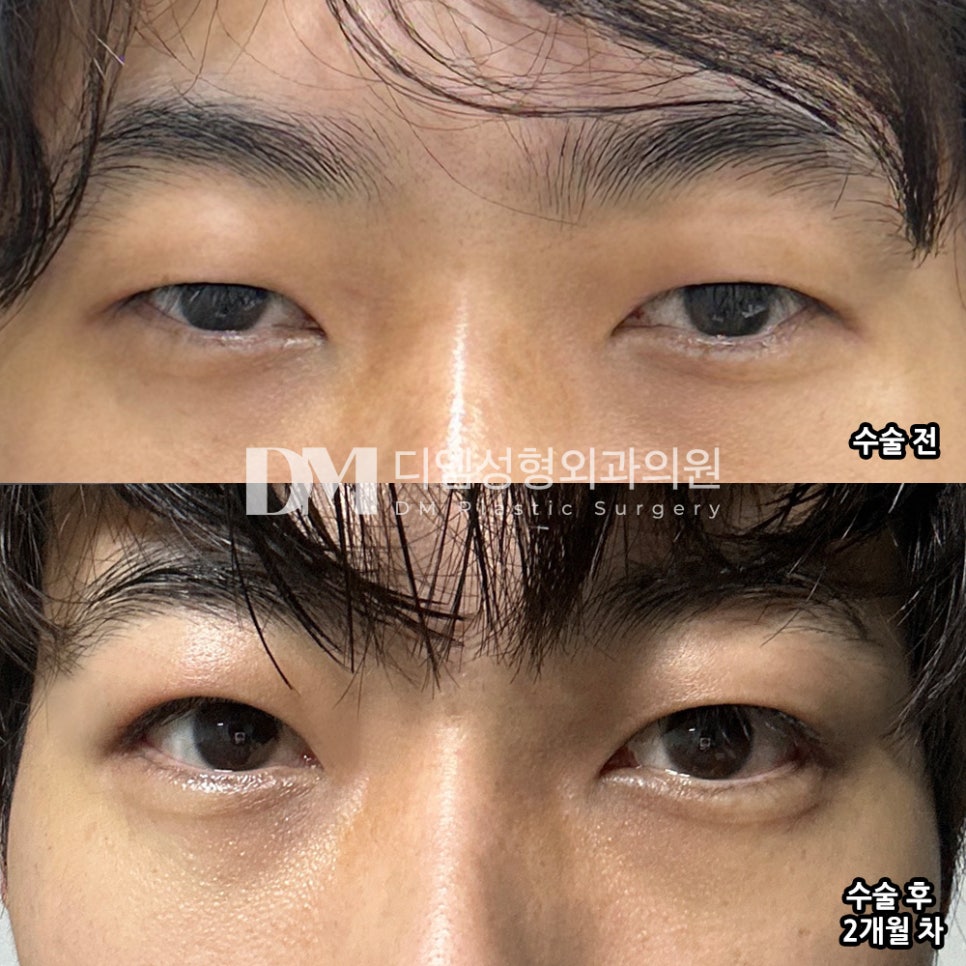 눈성형 후기."전반적으로 만족하고 있습니다!" 관련 이미지 2