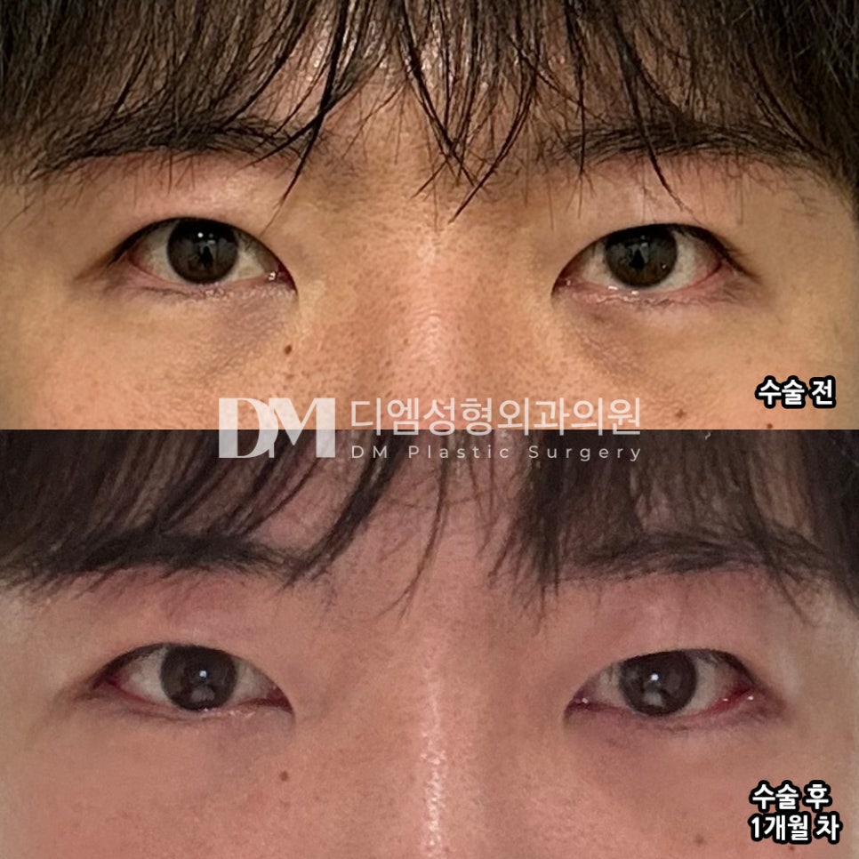 뒤밑트임 후기."확실히 가로로 길어진 게 느껴져서 만족스럽습니다." 관련 이미지 2