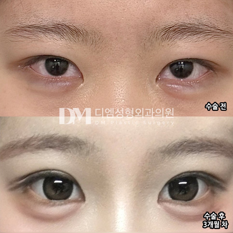 디엠 눈재수술 후기, “첫 수술 때보다 라인이 더 예쁘고 마음에 들었어요!” 관련 이미지 2
