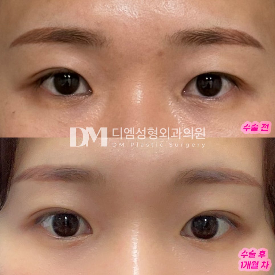 눈성형 후기."거의 몰라볼 정도로 자연스럽게 잘 되어 매우 만족해요!" 관련 이미지 2