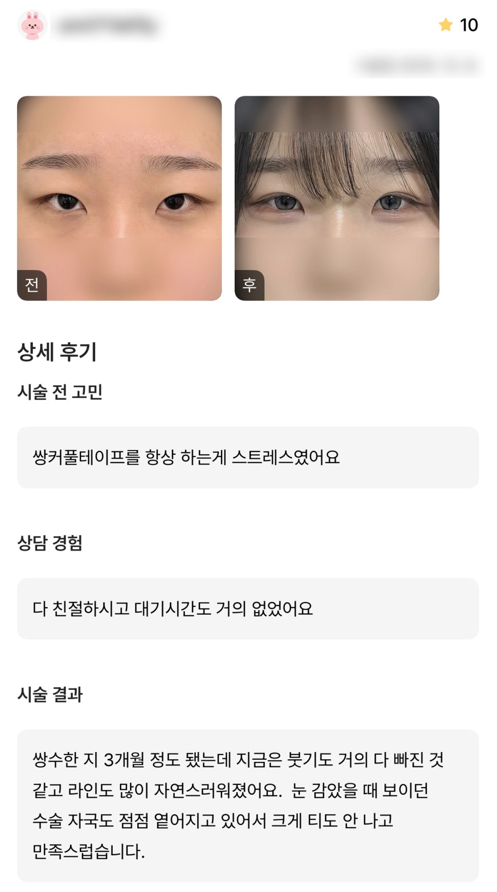 DM Eye-Shape Correction/Double-Eyelid Surgery Review, “I’m satisfied because it doesn’t look too obvious!” image 1
