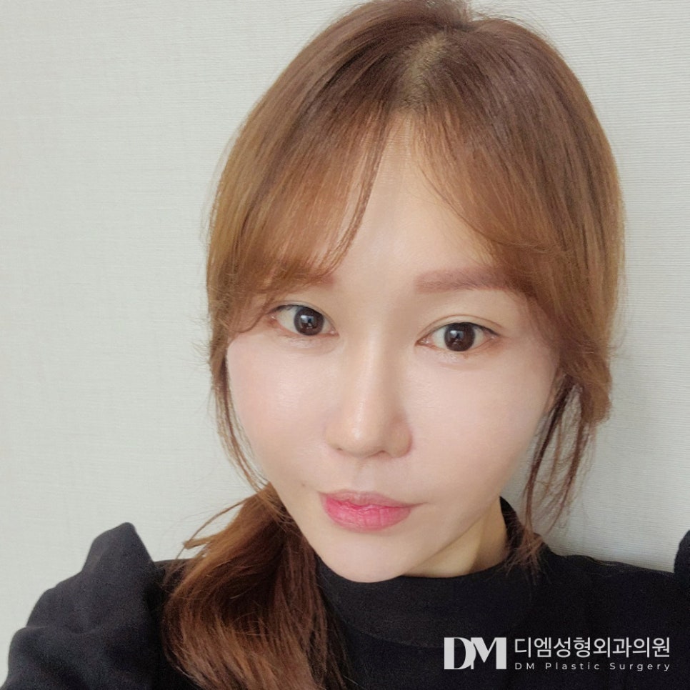 흉터 걱정 덜어주는 반거상술,안면거상과 차이는? 관련 이미지 14