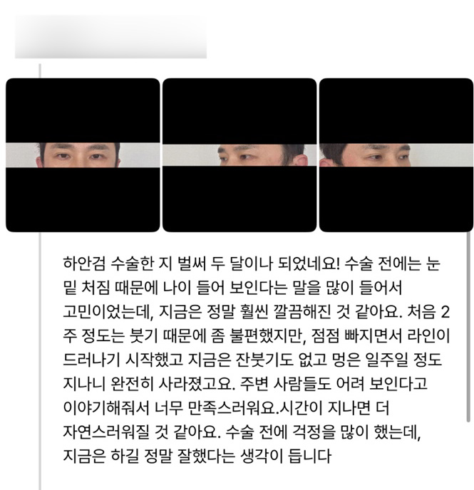 하안검 후기."지금은 하길 정말 잘했다는 생각이 듭니다" 관련 이미지 1