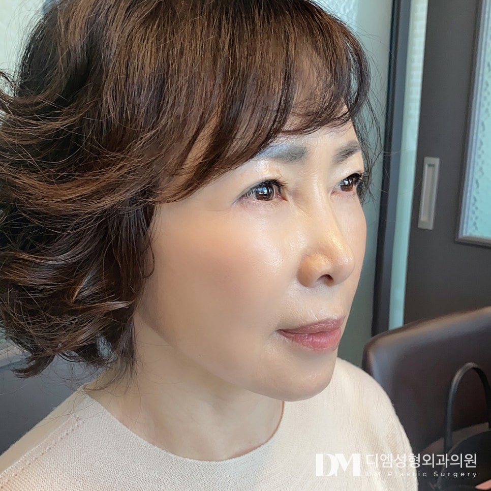 Facelift: Improving Sagging and Wrinkled Skin image 16