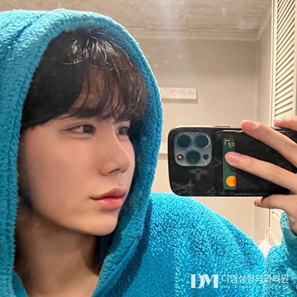 복코성형, 뭉툭한 인상 개선하기 관련 이미지 15
