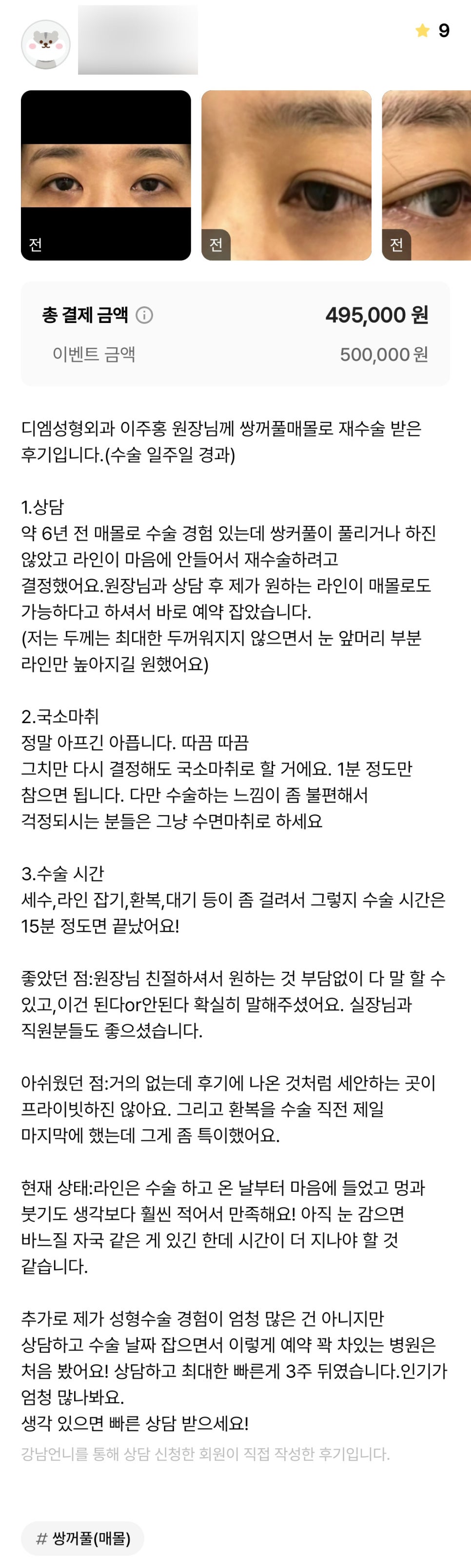 눈재수술 후기."수술 당일부터 멍과 붓기가 훨씬 적어서 만족해요!!" 관련 이미지 1