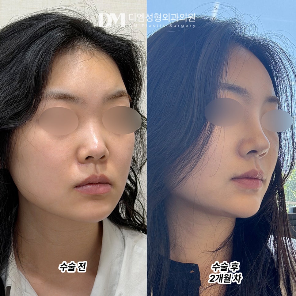 디엠 낮은코성형 후기, &ldquo;앞으로 더 예뻐질 모습이 기대됩니다!&rdquo; 관련 이미지 2