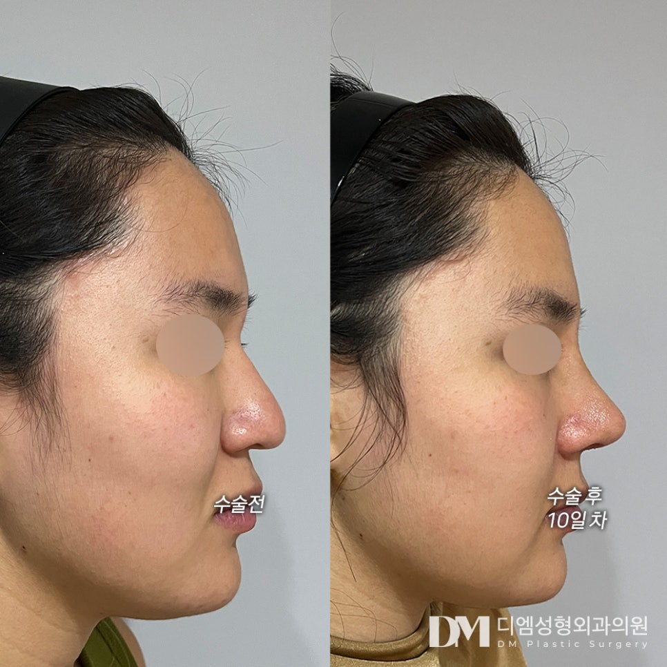화살코 성형, 컴플렉스 극복은 물론 자신감 충전까지 ! 관련 이미지 6