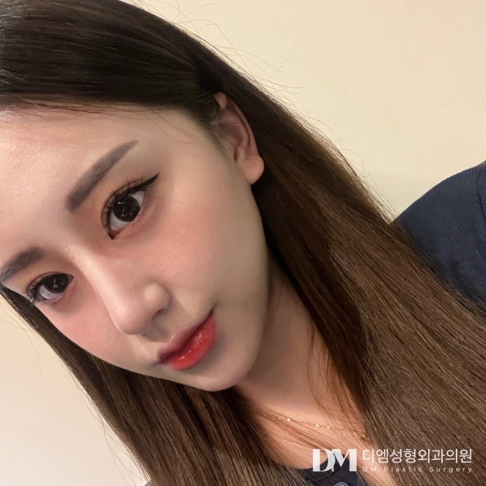 눈재수술, 쌍꺼풀이 풀려 비대칭 눈매가 되었다면? 관련 이미지 14
