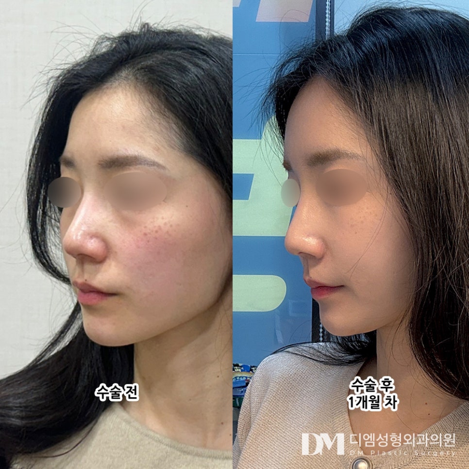 얼굴지방이식 후기."통증도 크게없고 일상 생활도 빨리 가능해서 좋았어요!" 관련 이미지 2