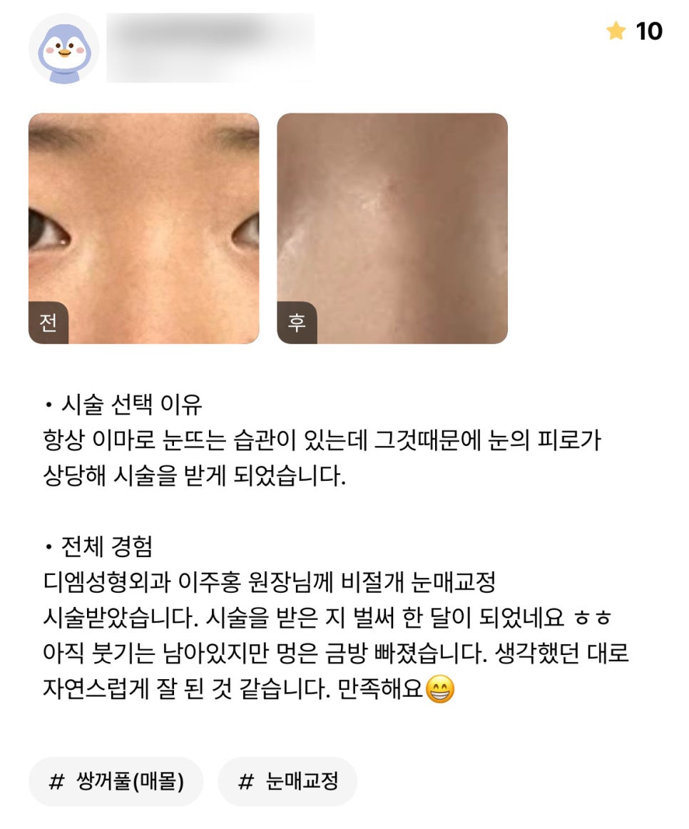 Eye Plastic Surgery Review. “I’m happy that it turned out as naturally as I imagined!” image 1