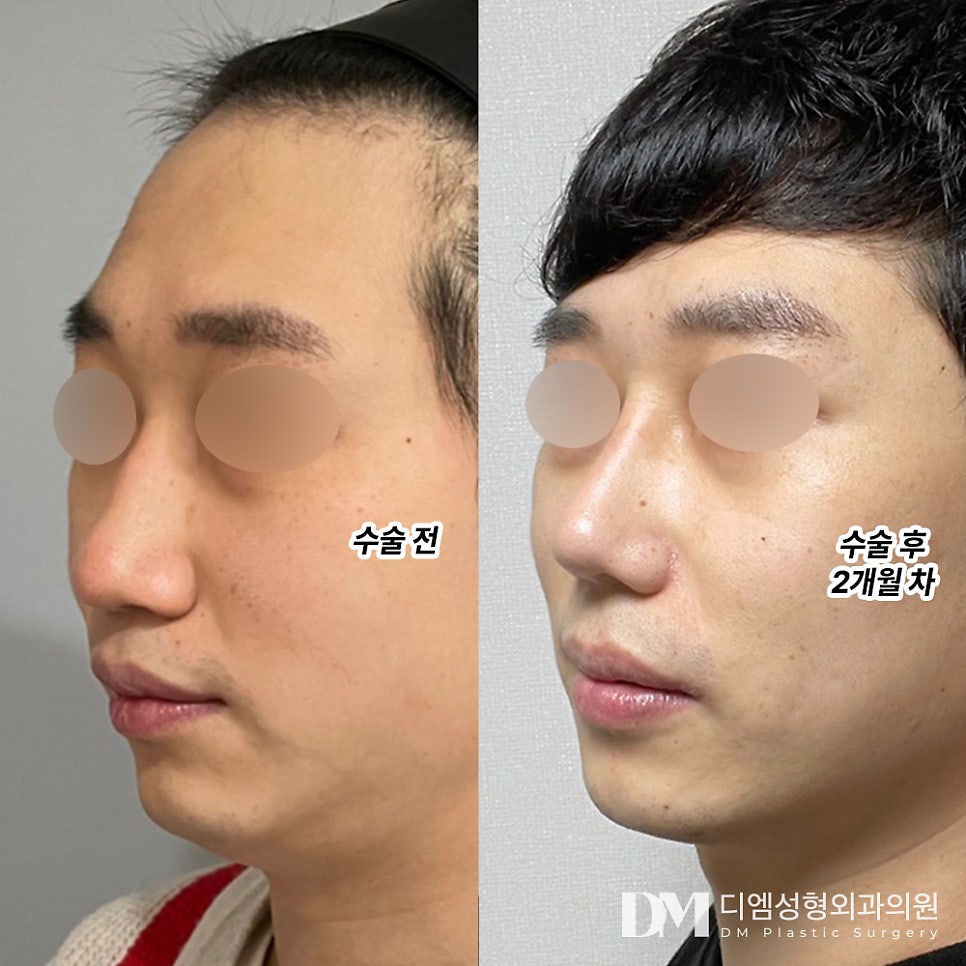 긴코성형, 짧은 중안부로 동안 되기 관련 이미지 6