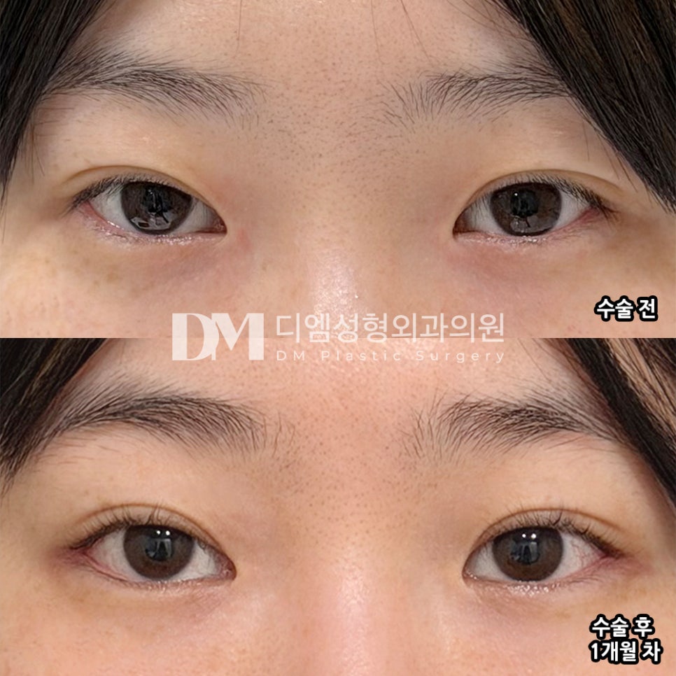 디엠 뒤밑트임/트임성형 후기, “전체적인 눈매가 훨씬 순하고 부드러워졌어요!” 관련 이미지 2