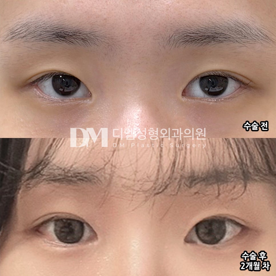 디엠 뒤밑트임/트임성형 후기, &ldquo;거울 볼 때마다 하길 잘했다는 생각이 들어요!&rdquo; 관련 이미지 2
