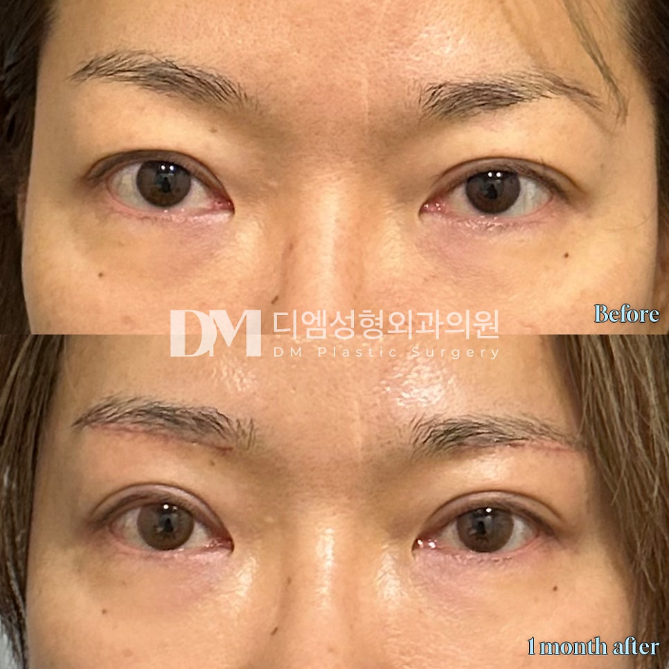 눈썹 하거상 후기."의사선생님도 신뢰가 가고 결과도 만족스러워요!" 관련 이미지 2