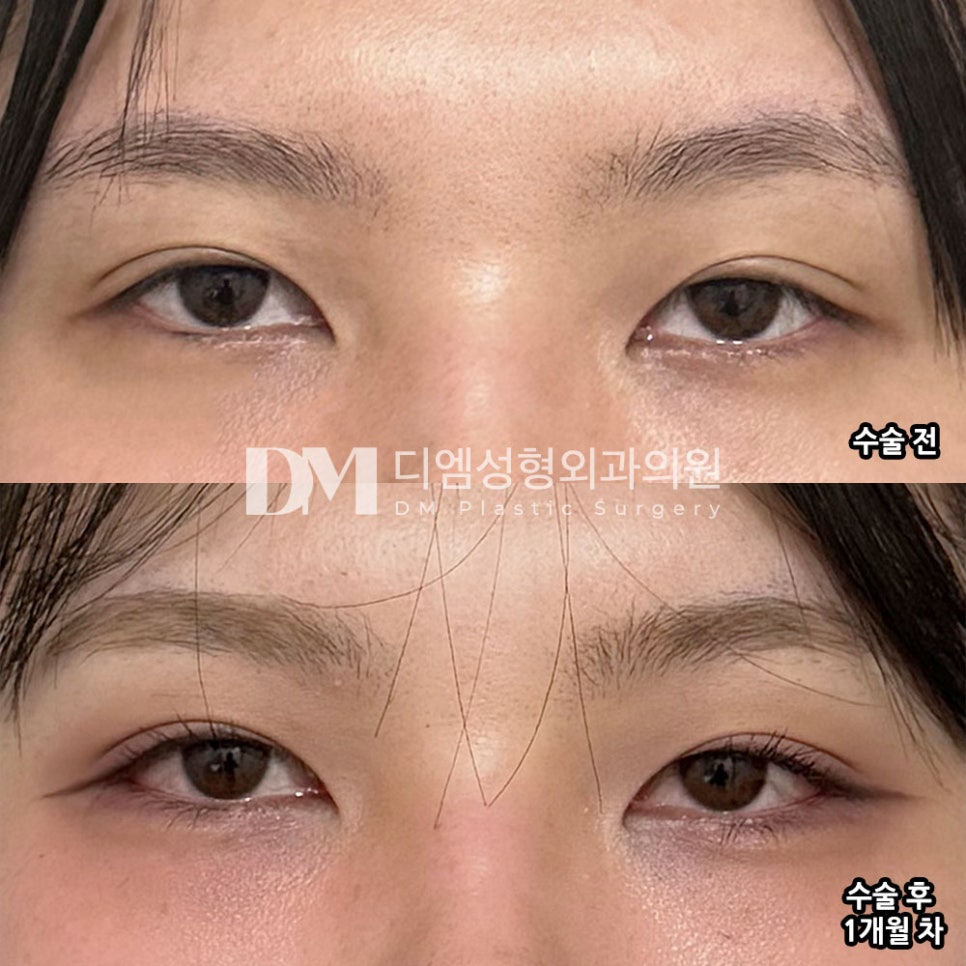 디엠 빵트임 수술후기, “자연스러운 느낌으로 결과가 나와서 너무 만족해요!” 관련 이미지 2