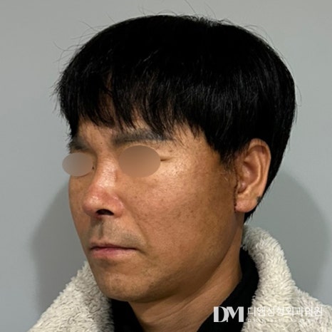 Facelift + Rhinoplasty Review: “Seeing the improvements comforted me after all the time I spent worrying!” image 3