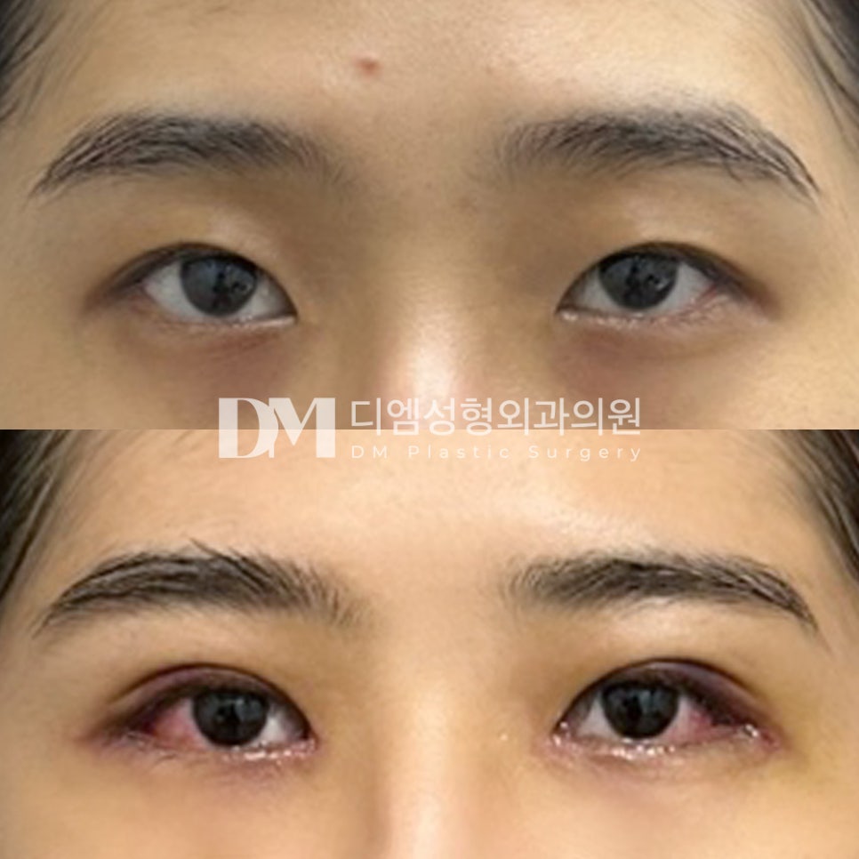 눈성형 후기."자연스럽게 잡혀 마음에들어요! 한달 후가 기대돼요!" 관련 이미지 2
