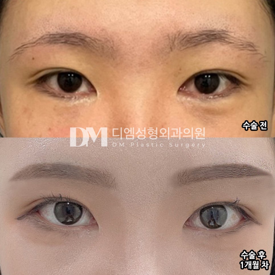 Ppangtteum Review. "It’s been a month, and I’m glad there’s no scar and the surgery finished quickly!" image 2