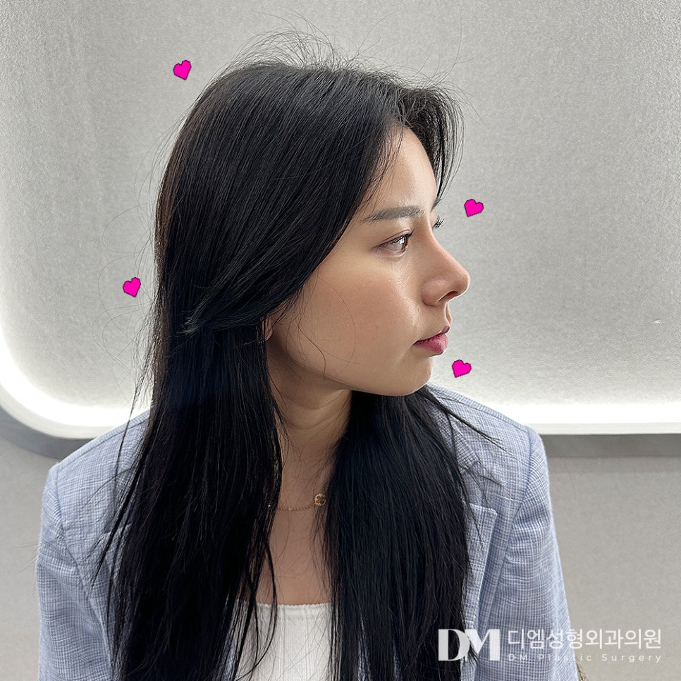 Rhinoplasty for a Hump Nose: What If the Tip Looks Drooped? image 10