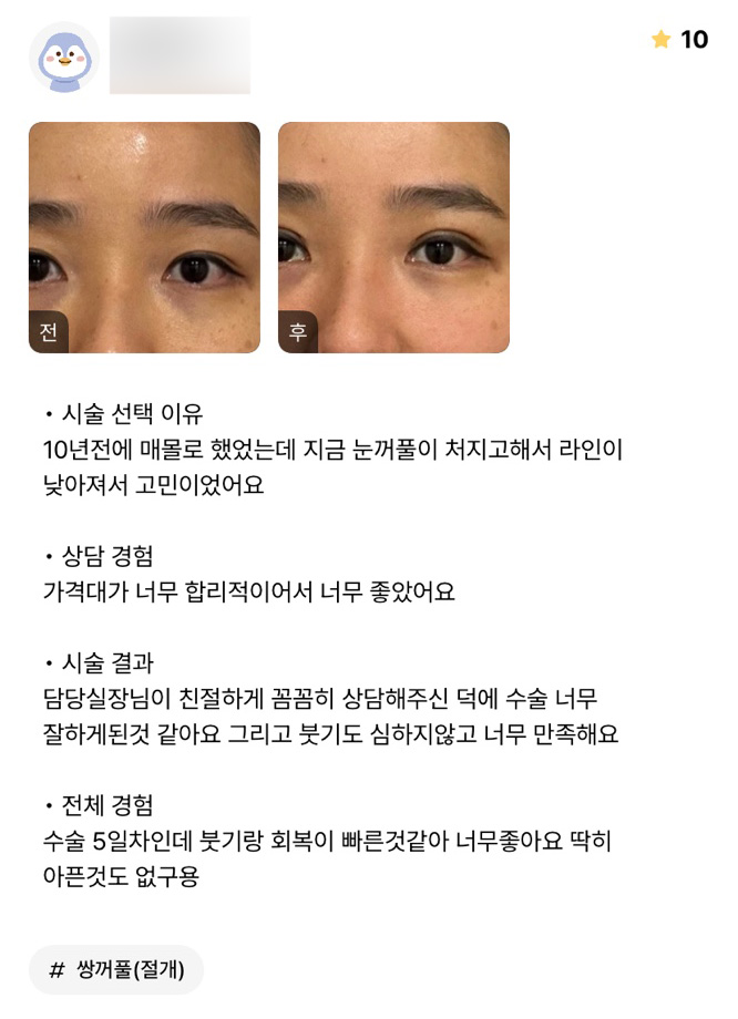 눈재수술 후기."회복도 빠르고 너무 좋아요!" 관련 이미지 1