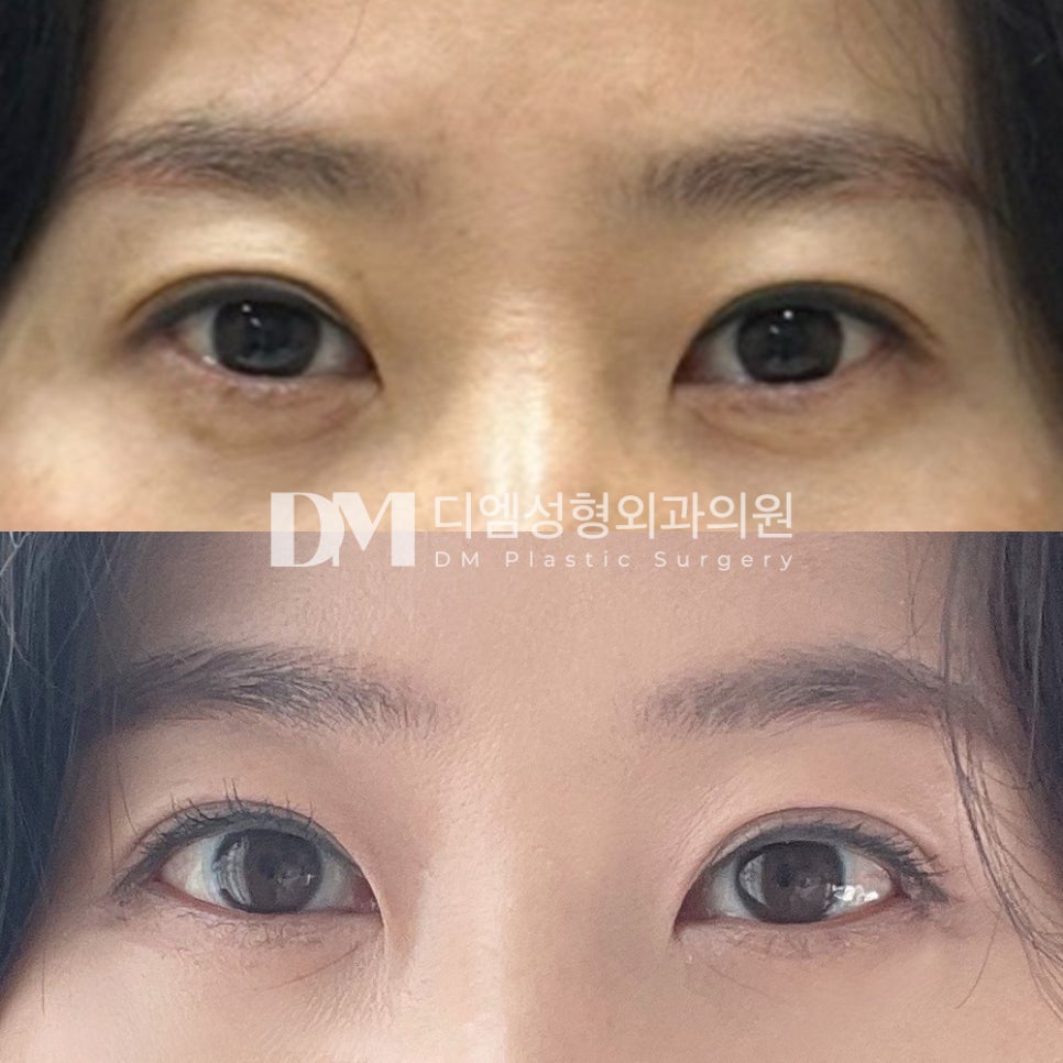 빵트임 후기."수술하길 잘했다 싶어요 만족해요!" 관련 이미지 2