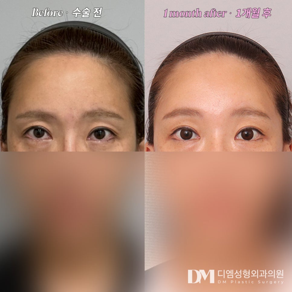 이마거상, 눈성형으로도 개선 안되는 처짐 개선 하기 관련 이미지 7