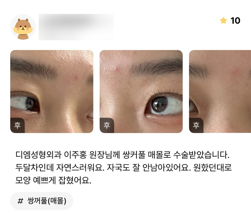 눈성형 후기."자연스럽고 원했던 대로 모양 예쁘게 잡혔어요!" 관련 이미지 1