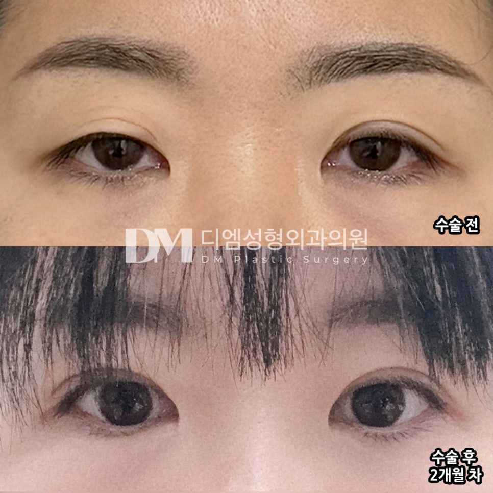 DM Revision Blepharoplasty Review, “I’m satisfied because they made it look pretty!” image 2