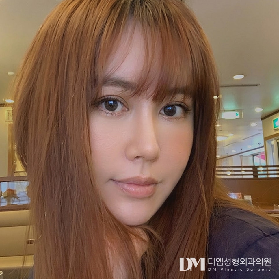 DM Revision Canthoplasty Before-and-After Photos: Afraid It Might Fail Again? image 1