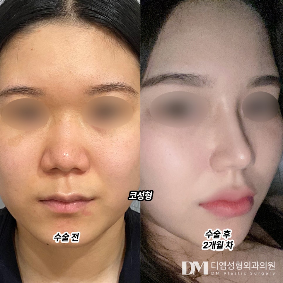 For Low-Nose Rhinoplasty, Focus on Balance Rather Than Simply Adding Height image 8