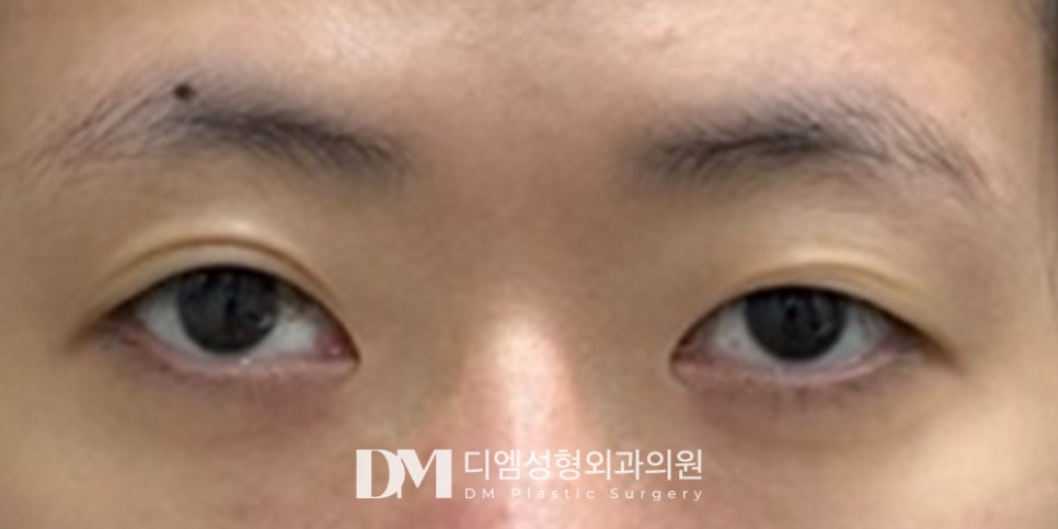 눈재수술, 1:1 정밀검사로 눈성형 실패원인 분석 및 진단은 필수! 관련 이미지 8