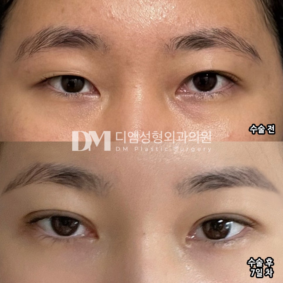 Double Eyelid Revision Surgery Review. "It’s not even been 2 weeks yet, but I’m already satisfied. I’m glad I got it done at DM!" image 2