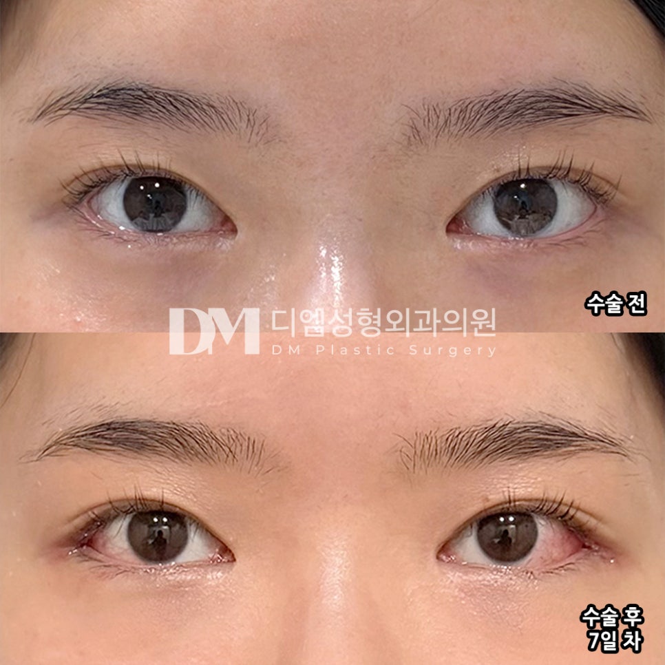 DM Lower Outer Eye Corner Surgery Review, “The effect of making my eyes look bigger is really satisfying!” image 2