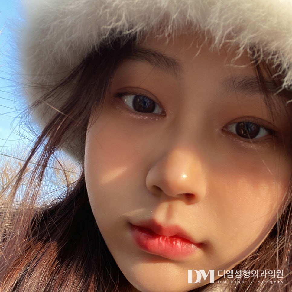 쌍꺼풀 수술, 내 눈에 적합한 방법은? 관련 이미지 14