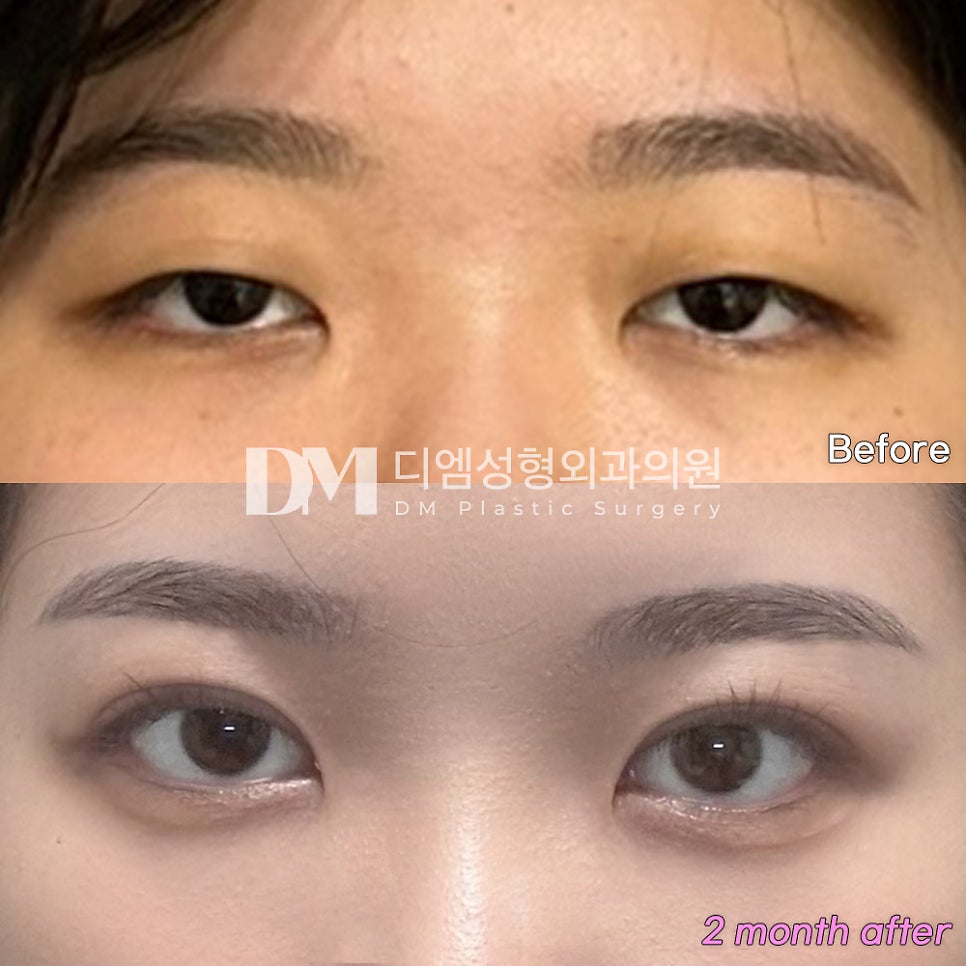 눈성형 후기."확실히 눈이 또렷해지고 인상이 부드러워졌대요!" 관련 이미지 2