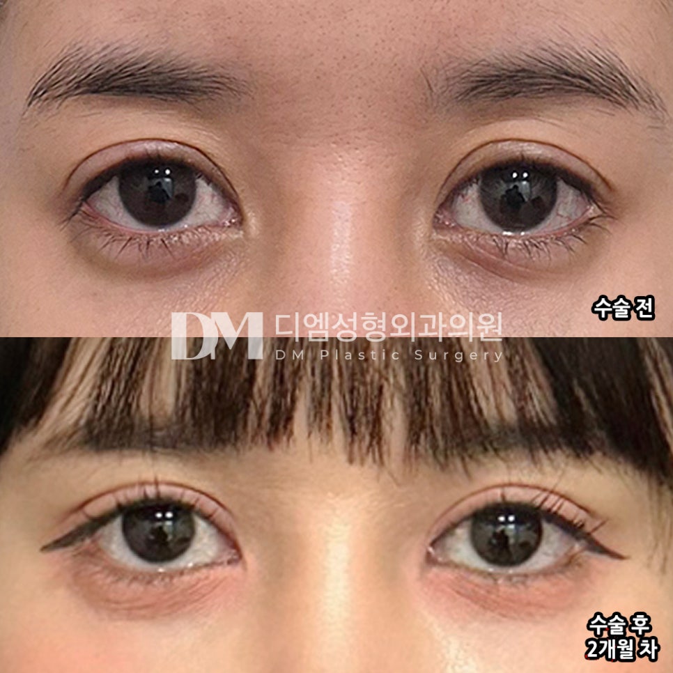디엠 눈재수술 수술후기, &ldquo;제가 원하던 라인으로 잘 되어서 마음에 들어요!&rdquo; 관련 이미지 2