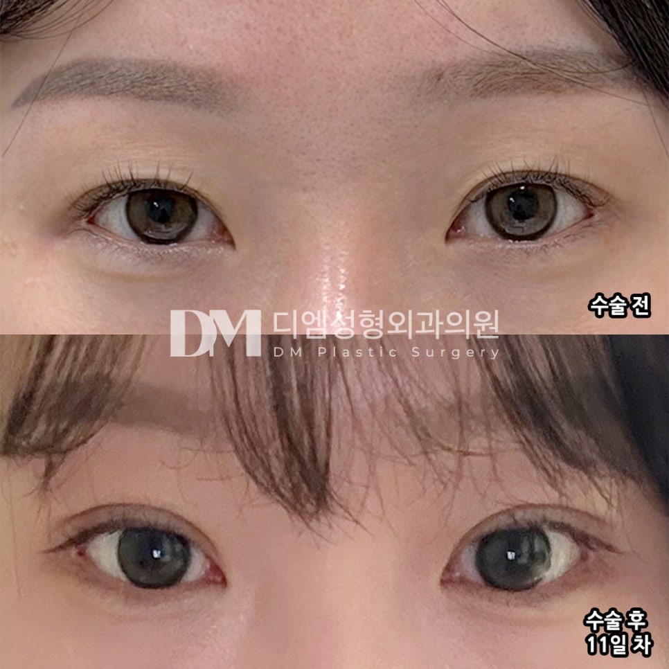 디엠 눈재수술 후기, “결과 넘넘넘 만족합니다!” 관련 이미지 2