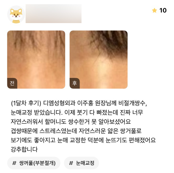 눈성형 후기."너무 자연스러워서 할머니도 못알아보셨어요!" 관련 이미지 1
