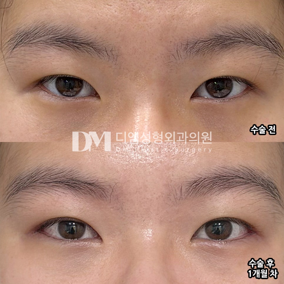 디엠 빵트임/트임성형 후기, &ldquo;과한 권유 없고 친절하게 설명해주셨어요!&rdquo; 관련 이미지 2
