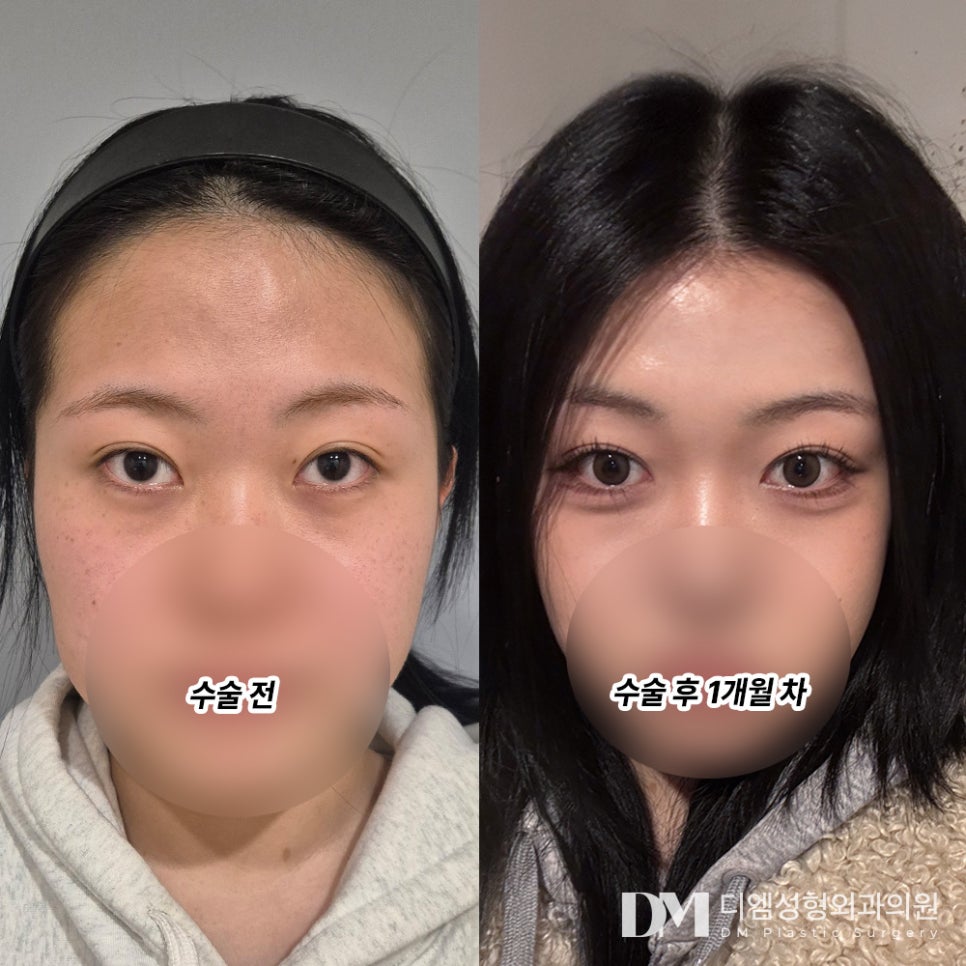 뒤밑트임 후기."꼼꼼한 상담에 안심이 됐어요!" 관련 이미지 2