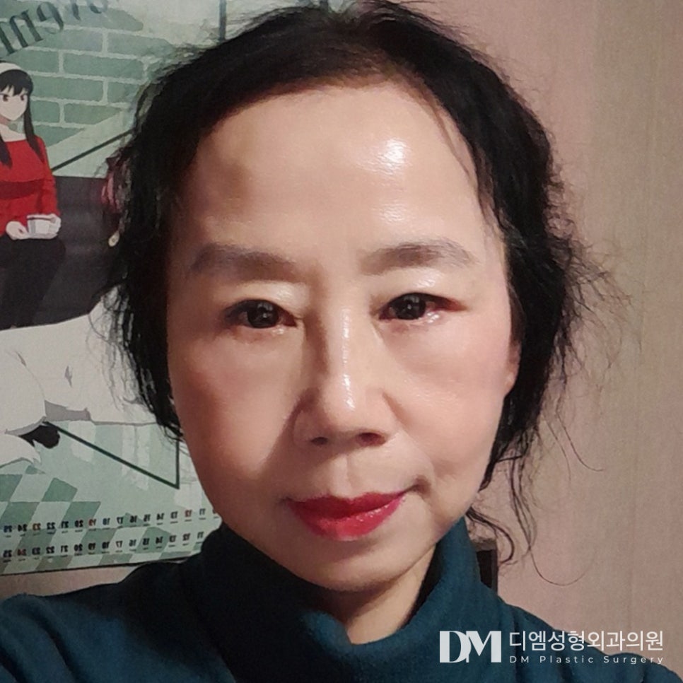 Facelift: Saving My Skin That Has Lost Elasticity and Become Saggy image 1
