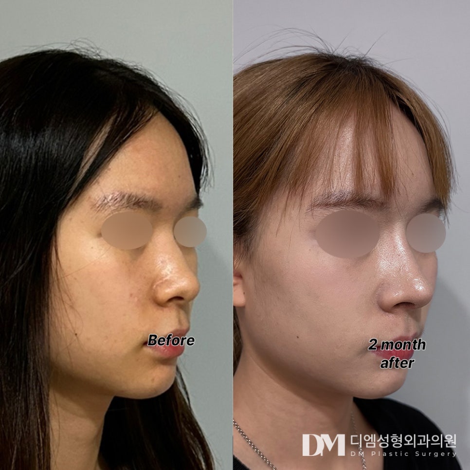 코성형 후기."결과에 무엇보다도 만족해요!" 관련 이미지 2
