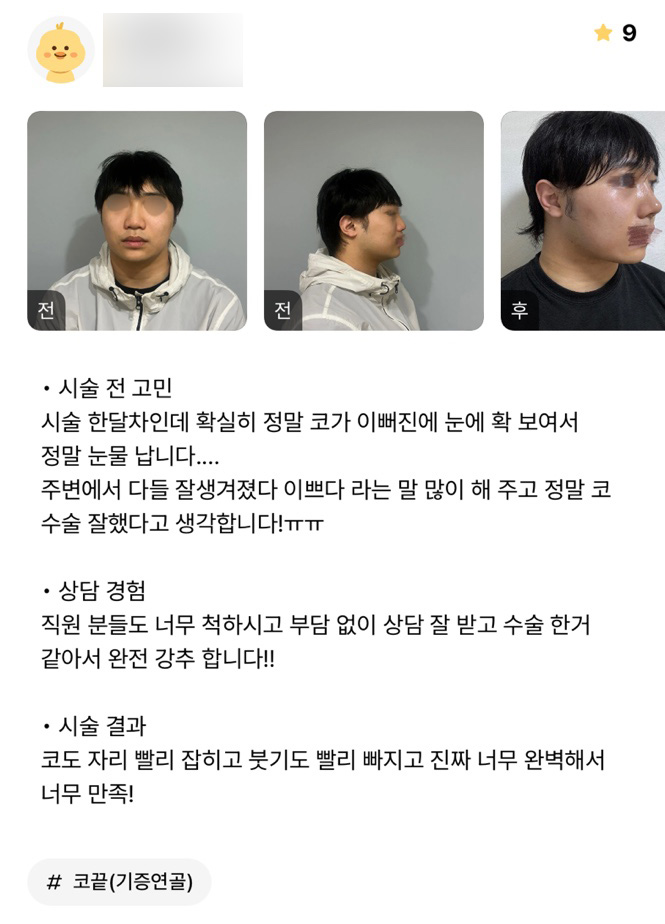 Rhinoplasty Review. "I’m so satisfied because it’s so perfect!" image 1