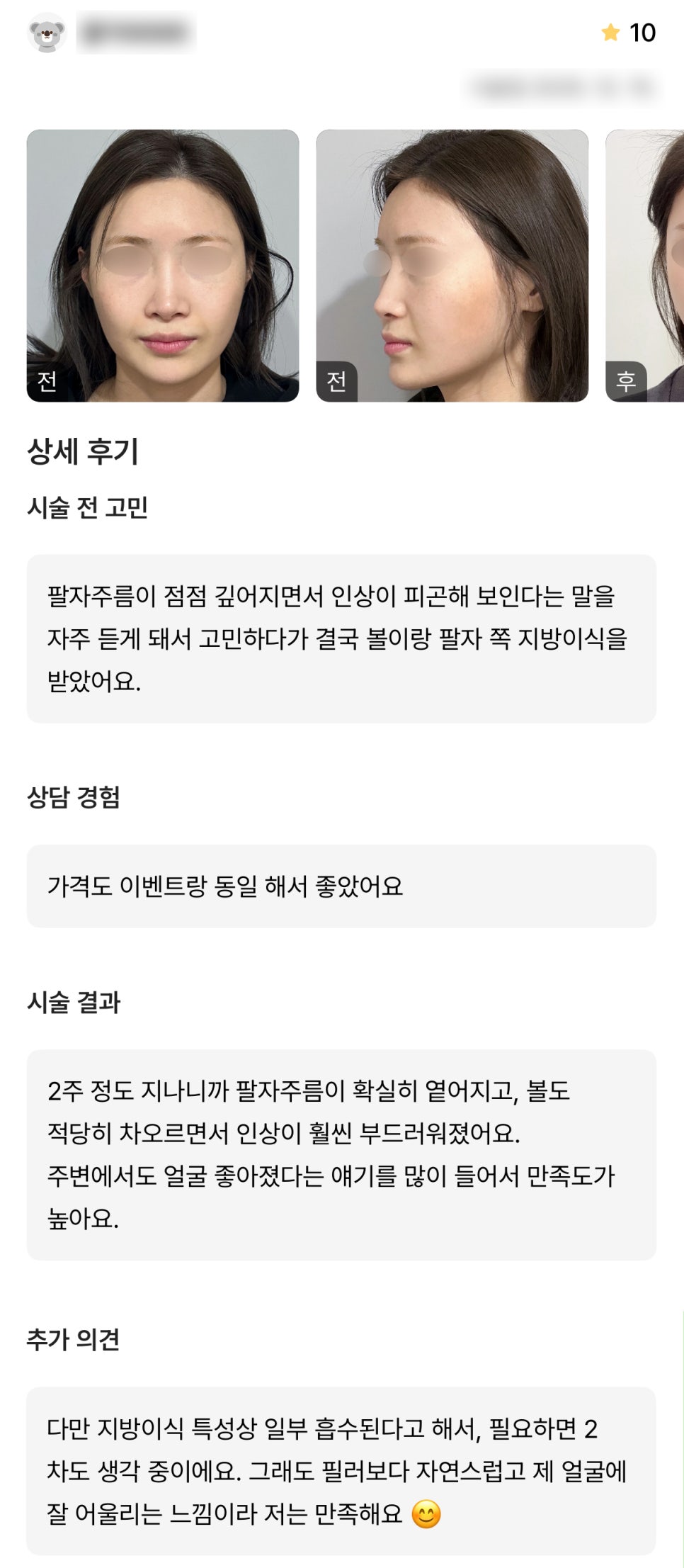 디엠 얼굴지방이식 후기, &ldquo;적당히 차오르면서 인상이 훨씬 부드러워졌어요!&rdquo; 관련 이미지 1