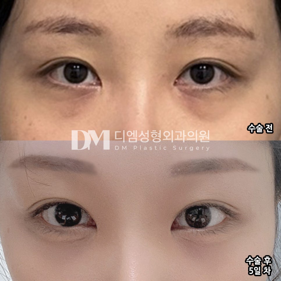 눈밑지방재배치 후기."멍이랑 붓기가 없어서 놀랬어요!" 관련 이미지 2