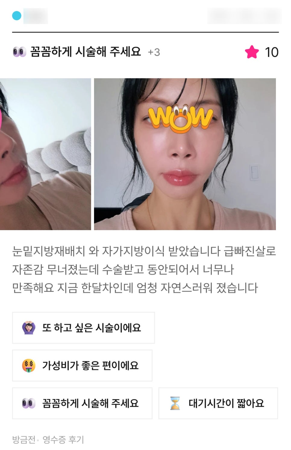 얼굴지방이식 후기."동안 되어서 너무나 만족해요!" 관련 이미지 1